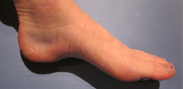 Example of an Ankle Sprain