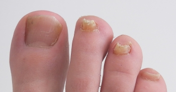 fungal toe nail