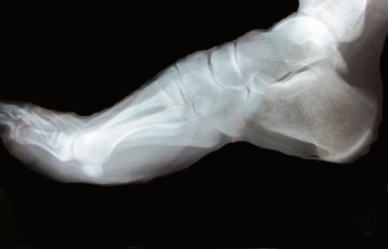 How foot stress fractures occur